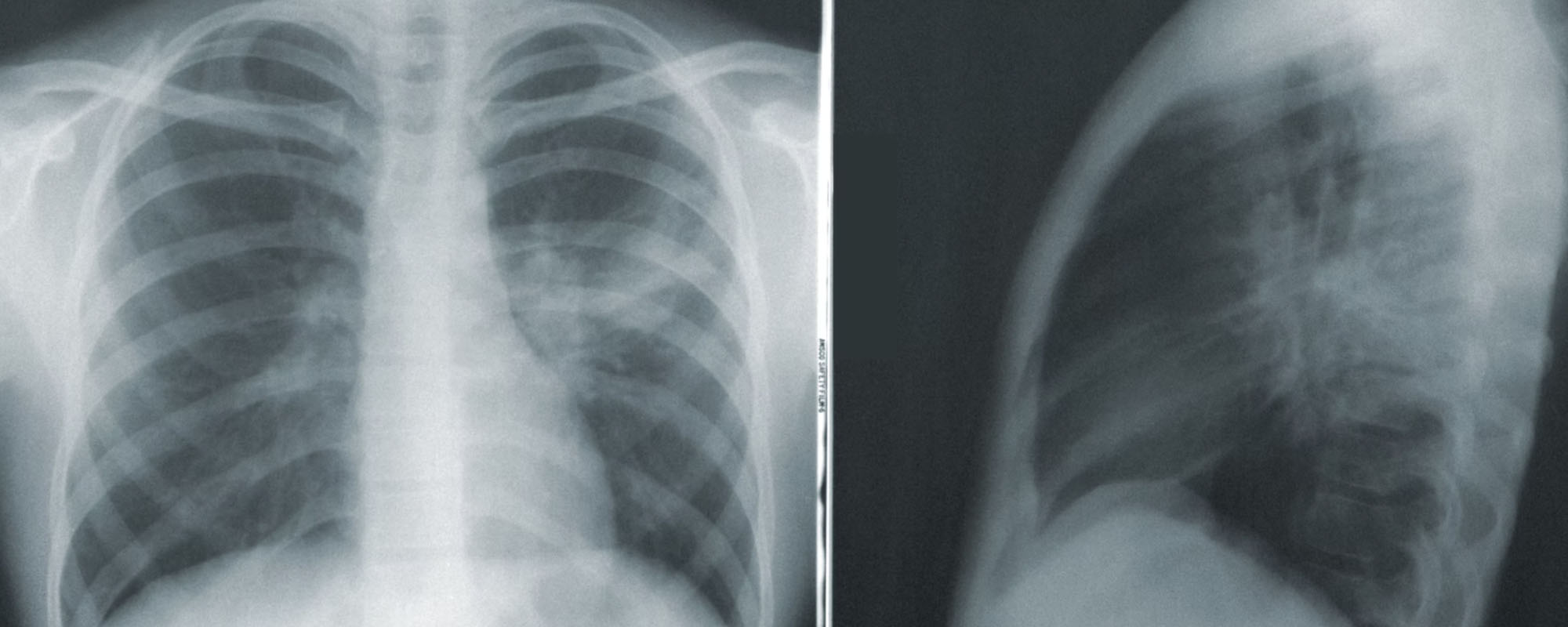 Global TB Deaths are Rising — is COVID to Blame?